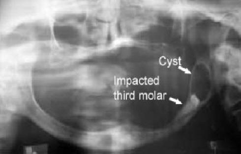 Large cyst