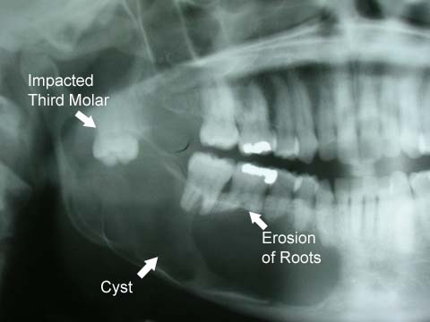 Consequences of impacted third molar