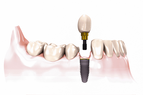 Single Tooth Screw Retained