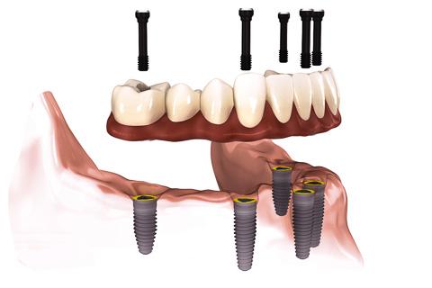 Complete Implant Denture