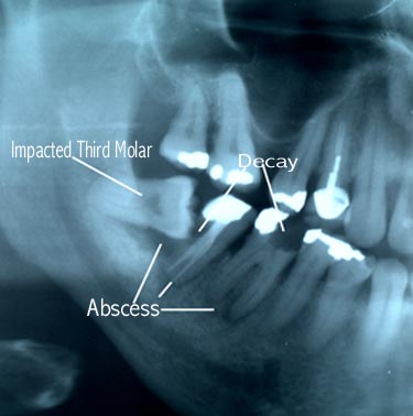 Impacted third molar